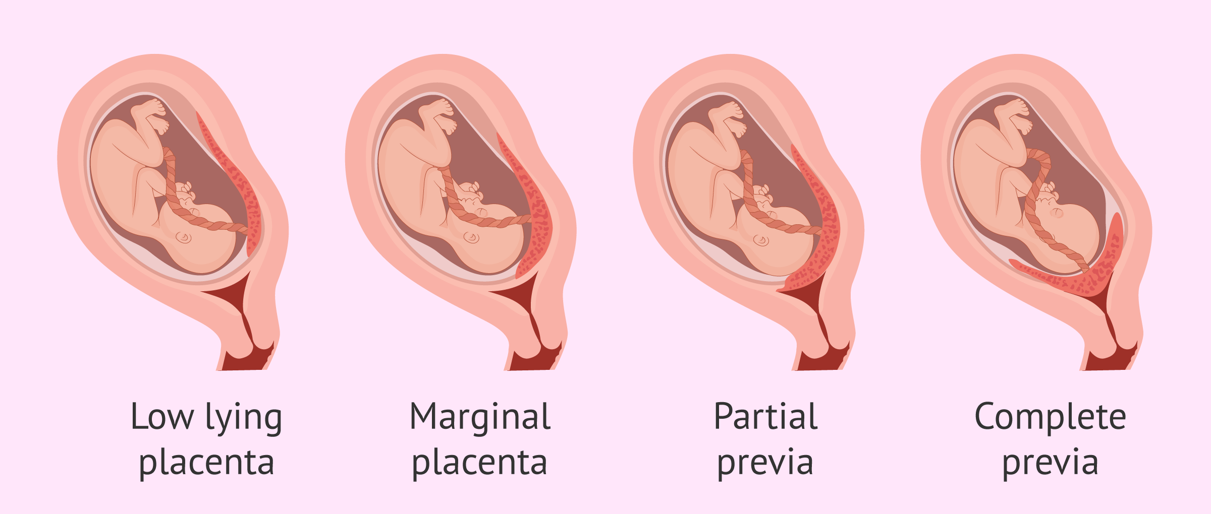 You are currently viewing Understanding Placenta Previa: Types, Complications, and Best Practices during Pregnancy