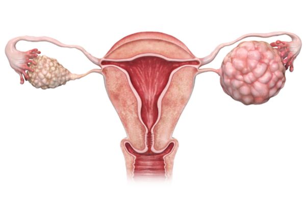 PCOS Treatment in Kanpur | Amrita Clinic